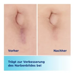 BepanCare Narben-Gel, 20 ml