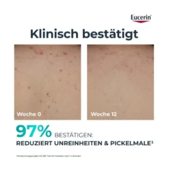 Eucerin DermoPure Clinical Erneuernde Körperlotion, 200 ml