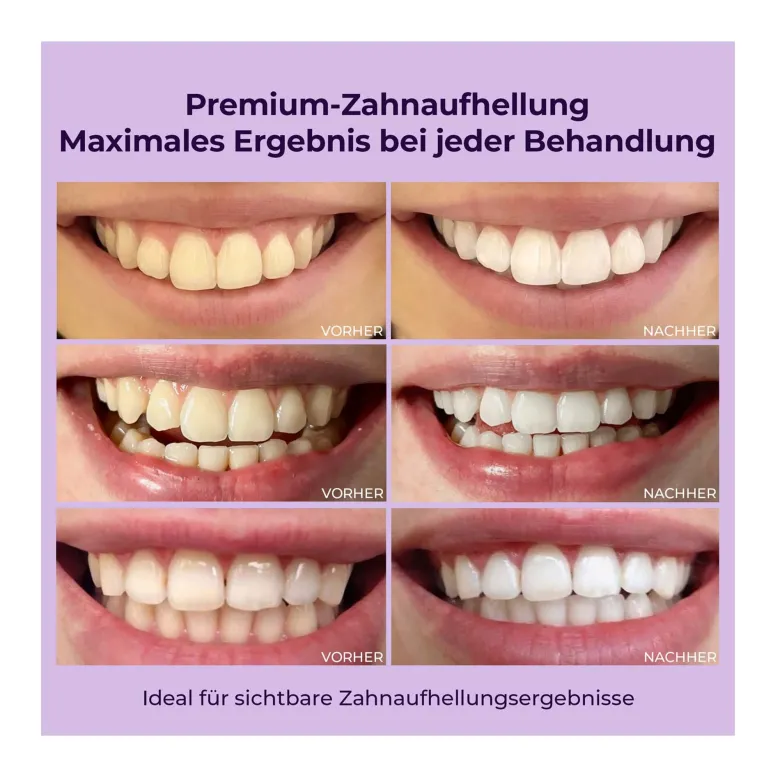 OnlySmile Zahnaufhellungsgel, 3X40 ml
