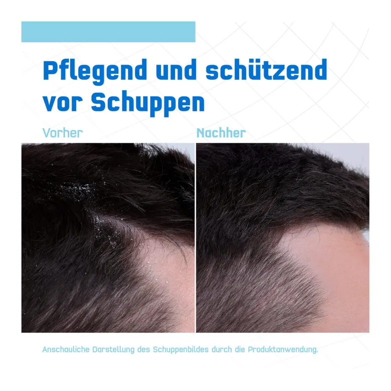 Terzolin Expert Shampoo bei trockener Kopfhaut, 200 ml